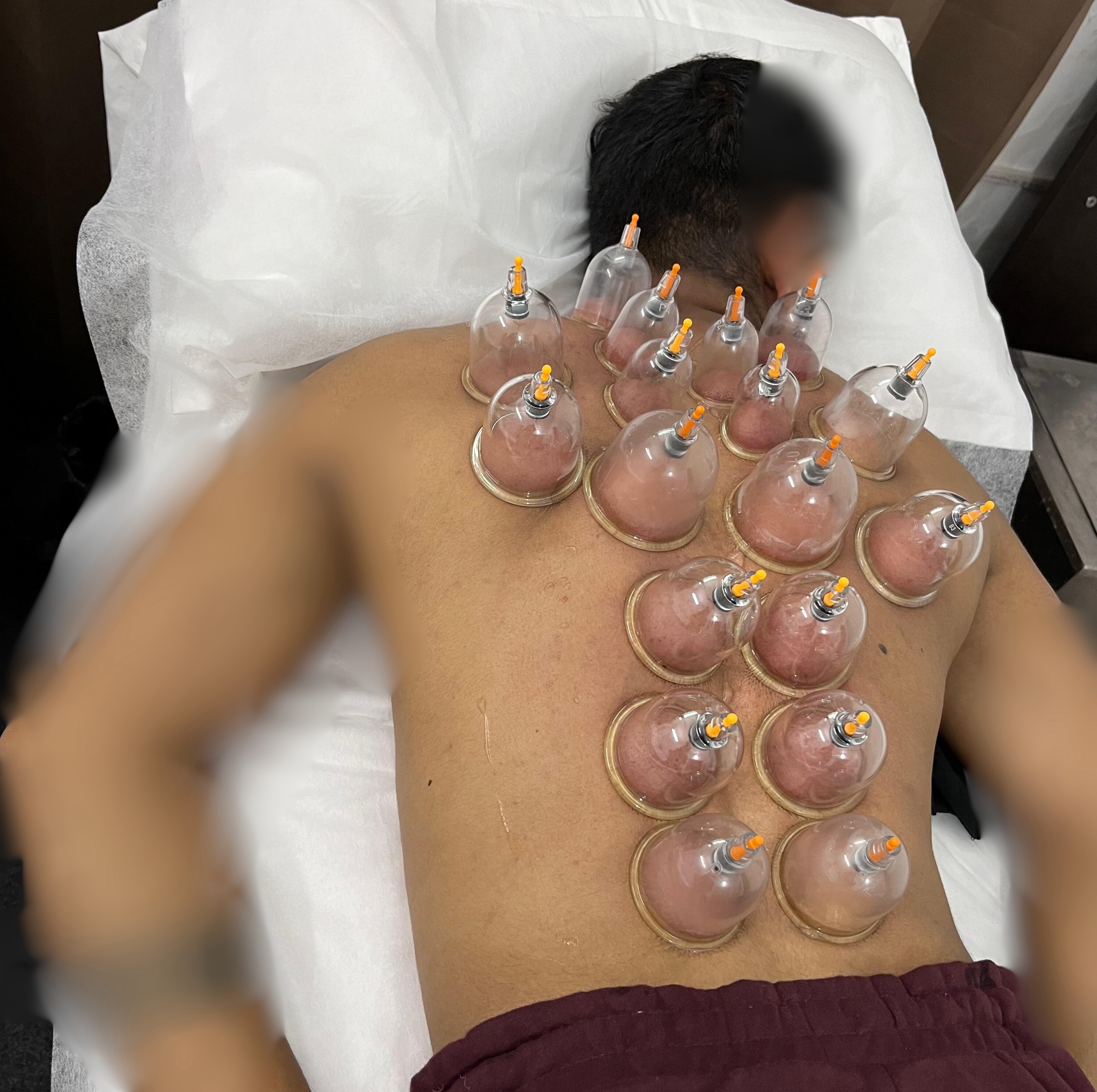 Patient getting cupping therapy