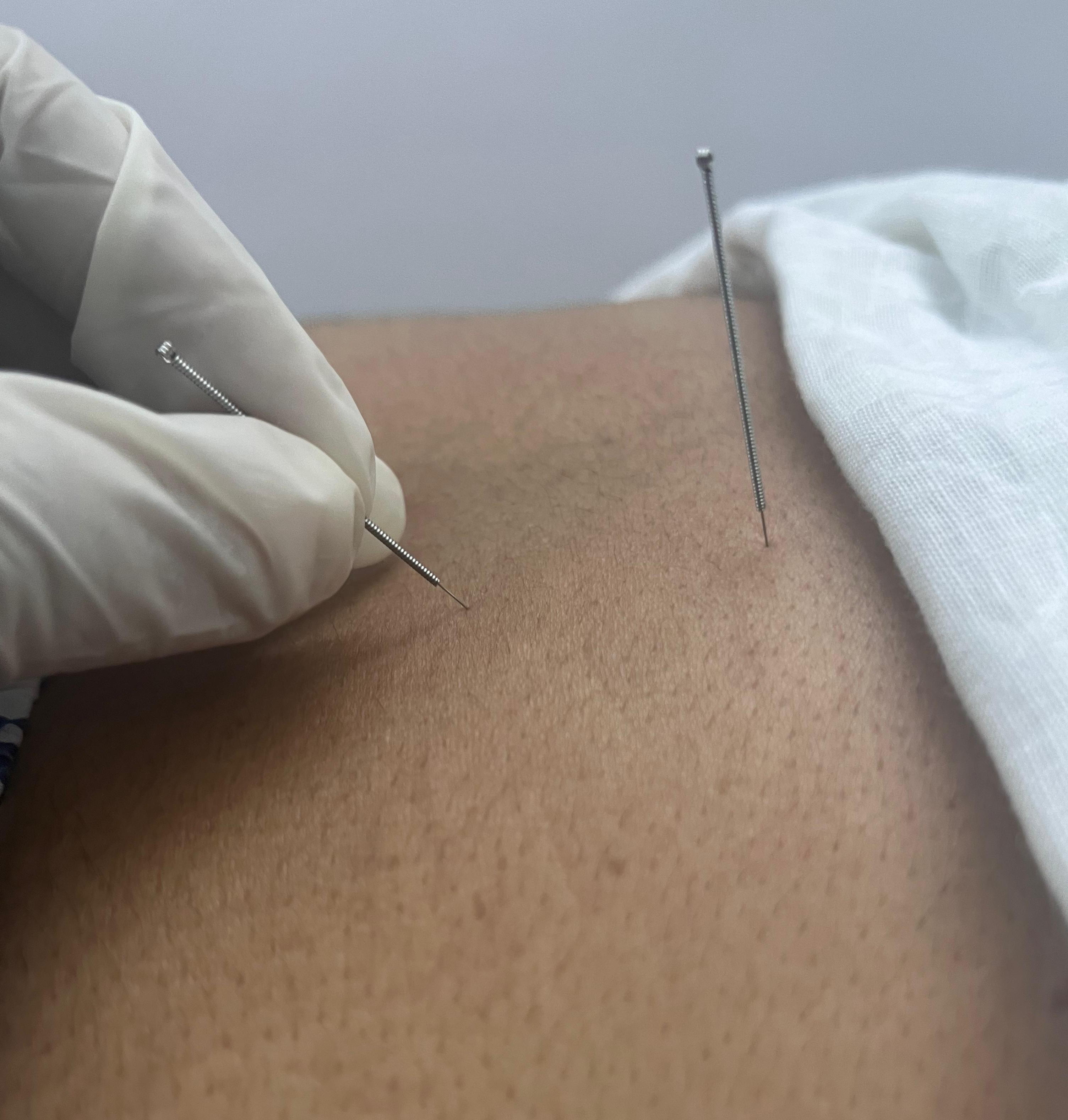 Needling therapy in action at our clinic